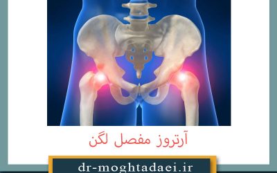 آرتروز مفصل لگن + علت، علائم و درمان
