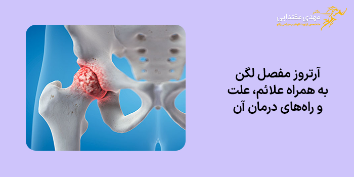 آرتروز مفصل لگن + علت، علائم و درمان