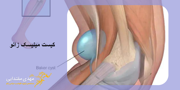 پیشگیری از ایجاد کیست مینیسک زانو