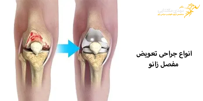 انواع جراحی تعویض مفصل زانو