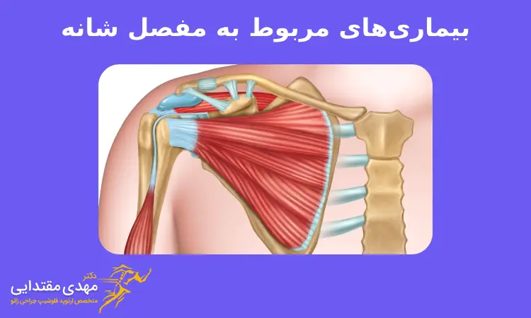 بیماری‌های مربوط به مفصل شانه