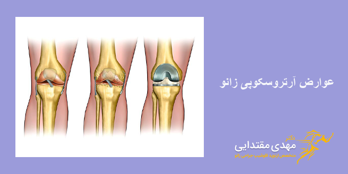 عوارض آرتروسکوپی زانو