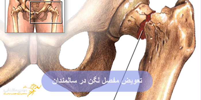 تعویض مفصل لگن در سالمندان