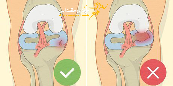 پارگی درجه 2 جراحی مینیسک زانو