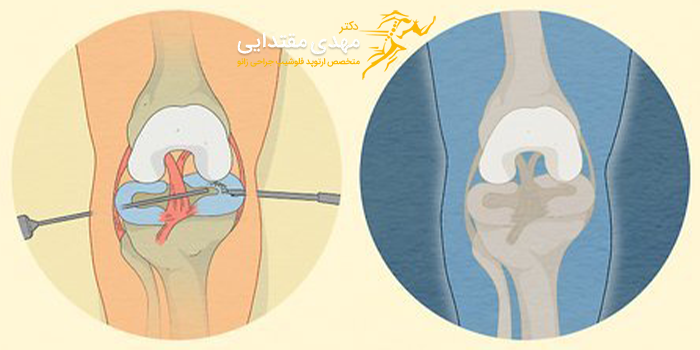 عوارض و خطرات جراحی مینیسک زانو در پارگی درجه 2