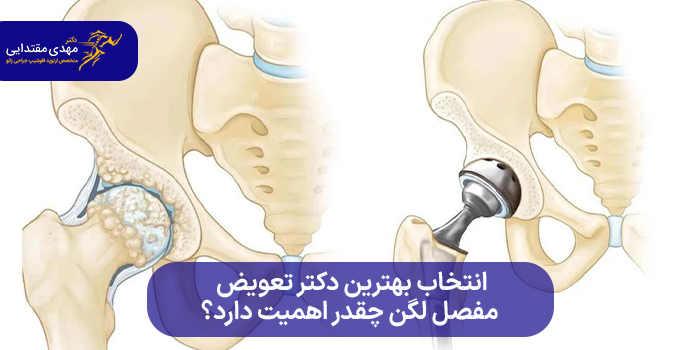 ویژگیهای بهترین دکتر تعویض مفصل لگن