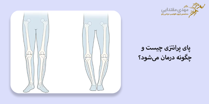 پا پرانتزی چیست و چگونه درمان میشود؟
