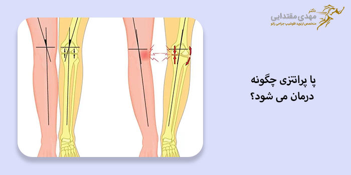 پا پرانتزی چگونه درمان می شود؟